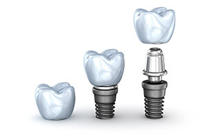 Dental Implants to Restore Your Teeth