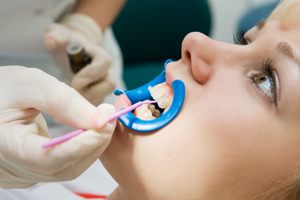 Dental Sealants to Block Out Decay!