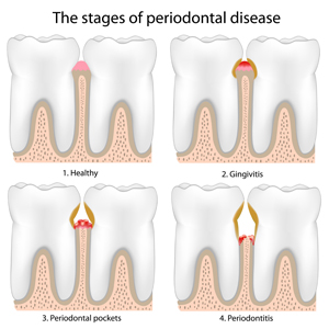 Laser Treatment Saves Teeth