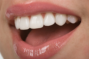 Porcelain Veneers—A Beautiful Alternative