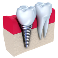 Am I a Candidate for Dental Implants?