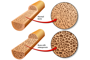 Osteoporosis: The Calcium Connection