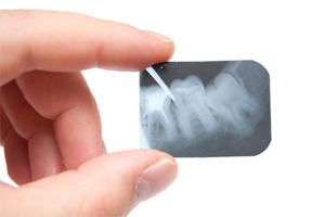 Dental X-Ray FAQs