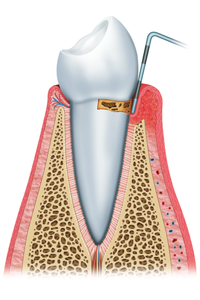 Periodontal Disease: It’s More Than Just Sore Gums