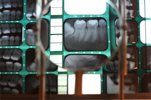 How Valuable are Dental X-rays, Really?