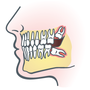 Wisdom Teeth Removal