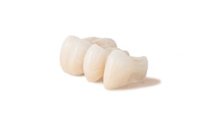 Caring for a Dental Bridge