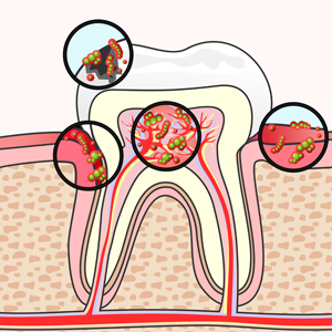 Can You Catch a Cavity?