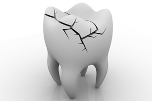 Learning More About Cracked Teeth