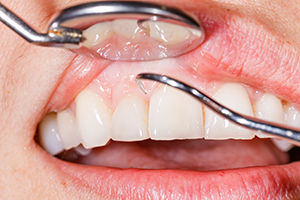 Could You Have Gum Disease?