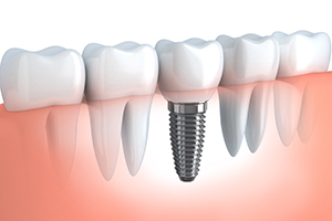 Dental Implants: The Next Best Thing to Natural Teeth