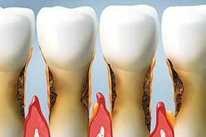 Root Surface Caries