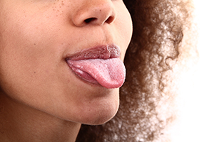 Tongue-Thrusting
