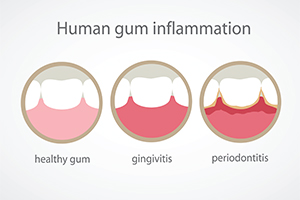 Baby Those Gums and Help Your Heart!