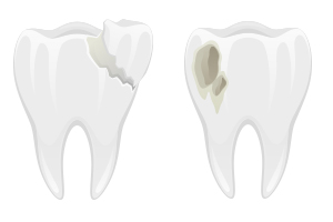 Even Tiny Tooth Cracks Need Attention