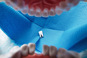 Have You Knocked Out a Tooth?