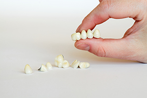 Crown and Bridge Treatment