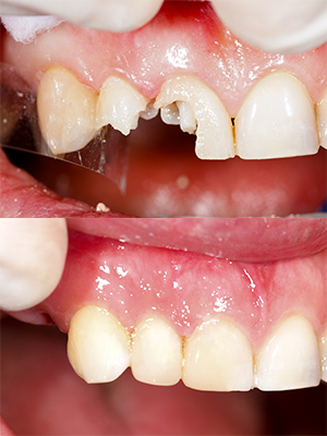 Changing Smiles by Bonding