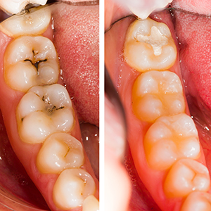 Repair Your Smile with Tooth Colored Fillings!