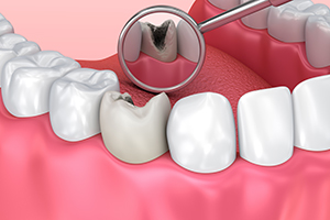 Cavities without Pain?
