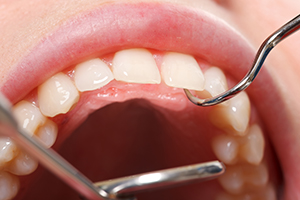 Are You at Risk for Gum Disease?